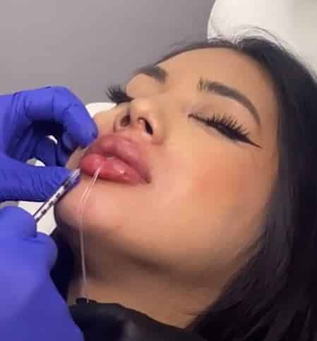 lip filler fort lauderdale