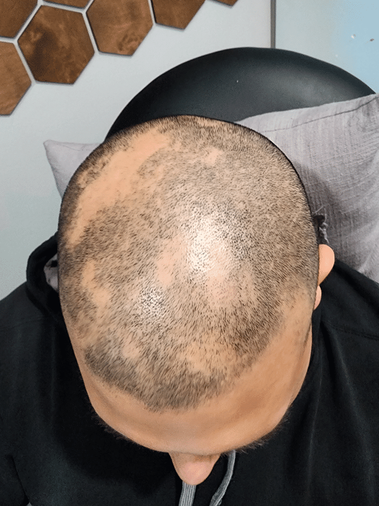 After Image: PRP Hair Restoration - front