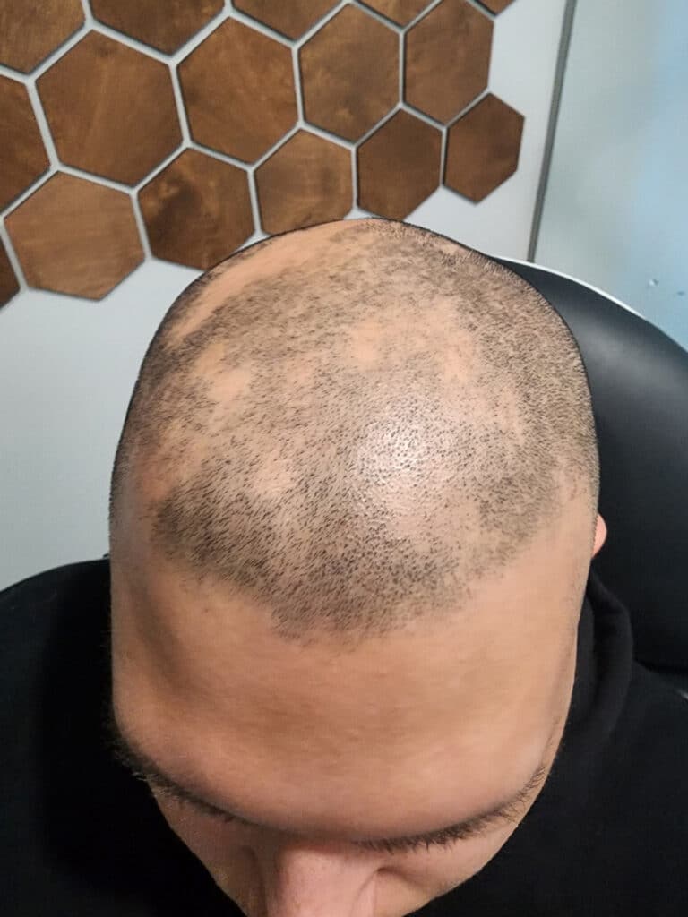 Before Image: PRP Hair Restoration - front