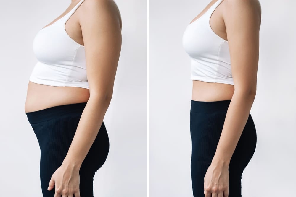 Before and after of a woman who has lost weight and toned her stomach after using Emsculpt Neo.