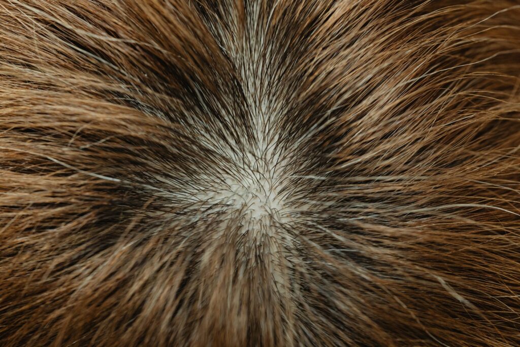 Hair Restoration