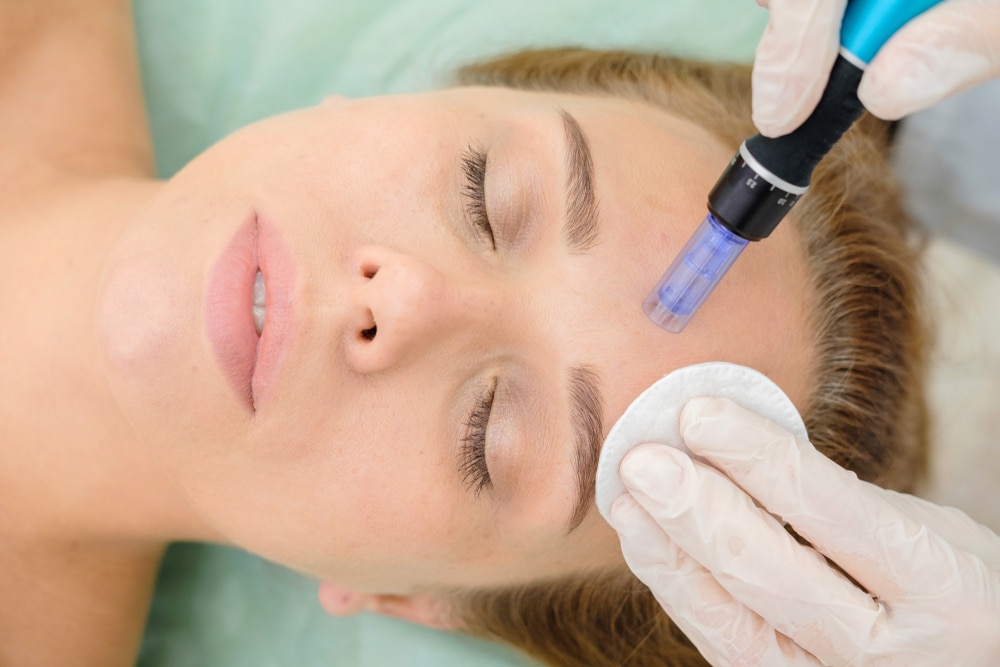 Top down image of a beautiful young woman receiving microneedling treatment for smoother, tighter skin.